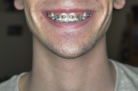 College of Dentistry speeds up teeth movement, braces process