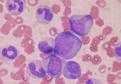 Student bone marrow campaign looks for donors